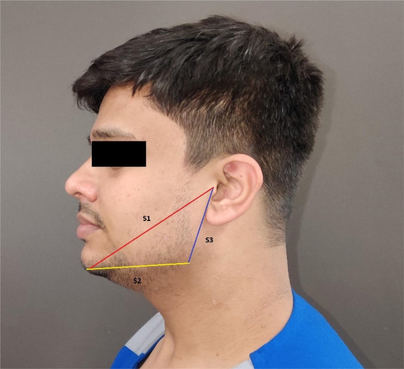 Comparative efficacy of bromelain and aceclofenac in limiting post-operative inflammatory sequelae in surgical removal of lower impacted third molar: a randomized controlled, triple blind clinical trial.