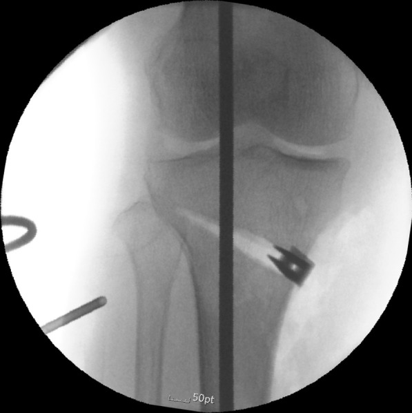 How to achieve an optimal alignment in medial opening wedge high tibial osteotomy?