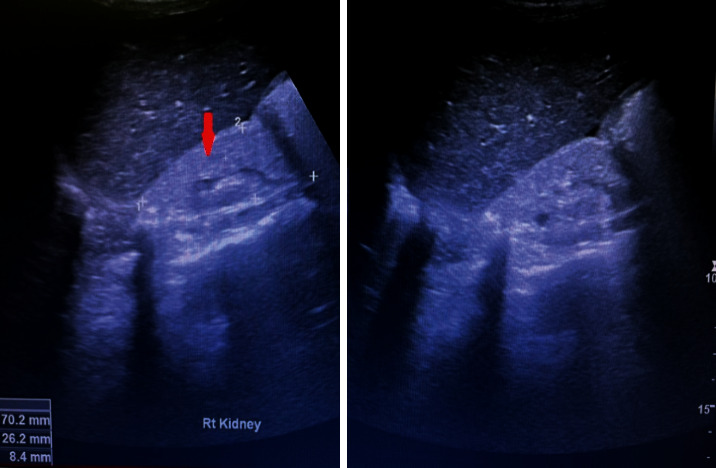 Coexistence of Lupus Nephritis, Ulcerative Colitis, and Communicating Hydrocephalus: A Report of a 21-Year-Old Male.