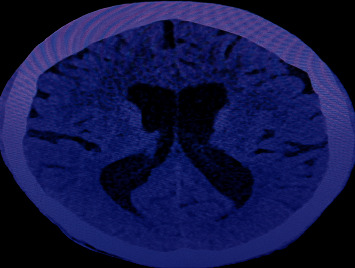 Coexistence of Lupus Nephritis, Ulcerative Colitis, and Communicating Hydrocephalus: A Report of a 21-Year-Old Male.