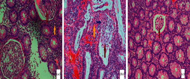 Coexistence of Lupus Nephritis, Ulcerative Colitis, and Communicating Hydrocephalus: A Report of a 21-Year-Old Male.