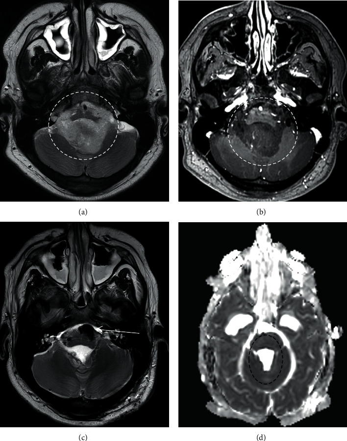 Basilar Artery Vasospasm as a Cause of Post-Operative Cerebellar Mutism Syndrome.