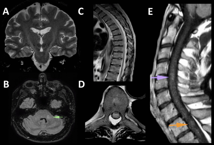 Guillain-Barré syndrome and fulminant encephalomyelitis following Ad26.COV2.S vaccination: double jeopardy.