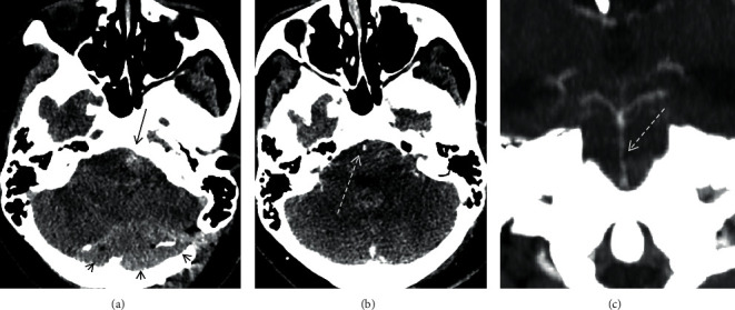 Basilar Artery Vasospasm as a Cause of Post-Operative Cerebellar Mutism Syndrome.