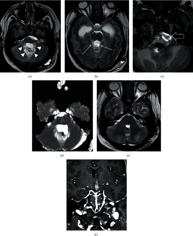 Basilar Artery Vasospasm as a Cause of Post-Operative Cerebellar Mutism Syndrome.