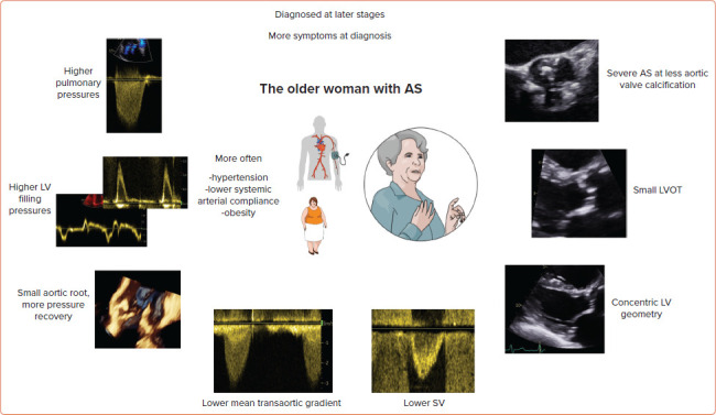 Grading of Aortic Stenosis: Is it More Complicated in Women?