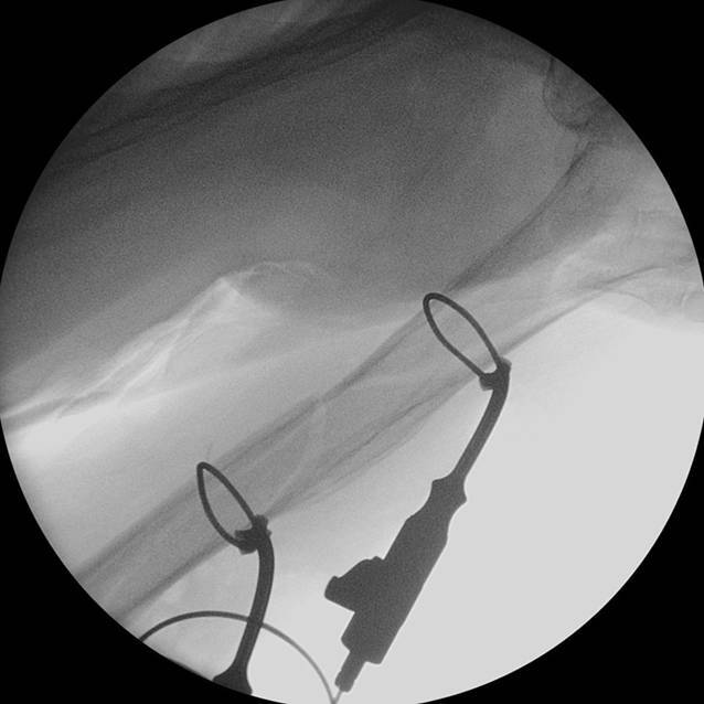 [Compromising due to additive cerclages : Can surgical treatment of humeral shaft fractures cause damage to the radial nerve?]