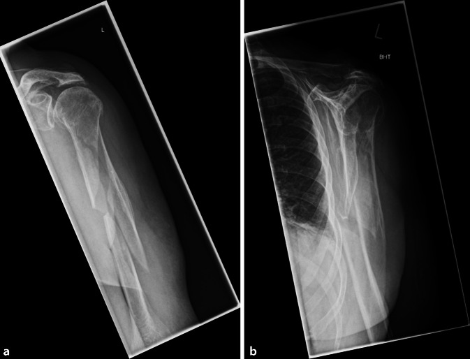 [Compromising due to additive cerclages : Can surgical treatment of humeral shaft fractures cause damage to the radial nerve?]