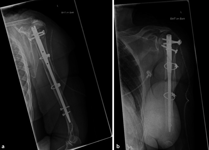 [Compromising due to additive cerclages : Can surgical treatment of humeral shaft fractures cause damage to the radial nerve?]