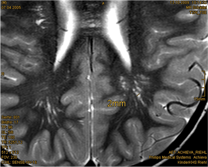 PTEN hamartoma tumor syndrome in childhood and adolescence-a comprehensive review and presentation of the German pediatric guideline.