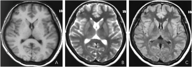 A low-grade cerebral arteriovenous malformation suspected of being a metastatic tumor: A case report and literature review