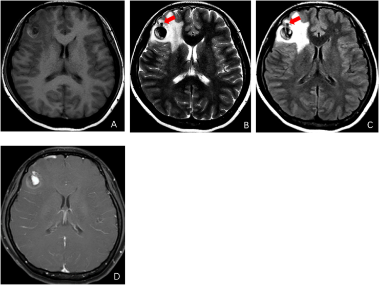 A low-grade cerebral arteriovenous malformation suspected of being a metastatic tumor: A case report and literature review