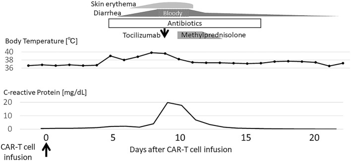Severe bloody diarrhea due to cytokine release syndrome after chimeric antigen receptor T cell therapy for refractory acute lymphoblastic leukemia.