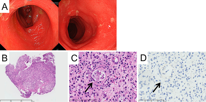 Severe bloody diarrhea due to cytokine release syndrome after chimeric antigen receptor T cell therapy for refractory acute lymphoblastic leukemia.