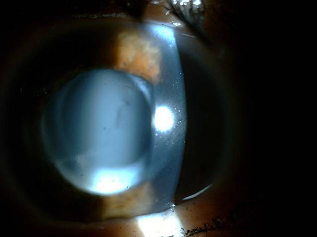 [Bilateral capsular block syndrome 7 years after cataract surgery].