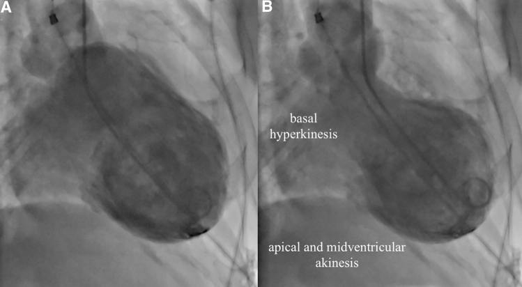 The role of central autonomic nervous system dysfunction in Takotsubo syndrome: a systematic review.