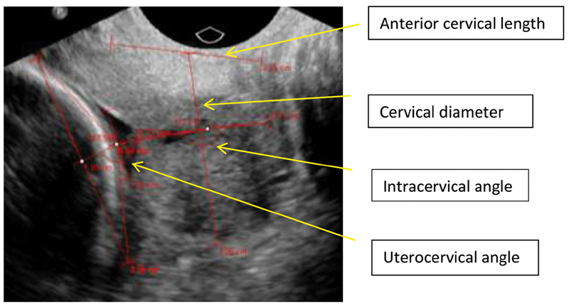 Transvaginal Sonographic Assessment Following Cervical Pessary Placement for Preterm Birth Prevention.