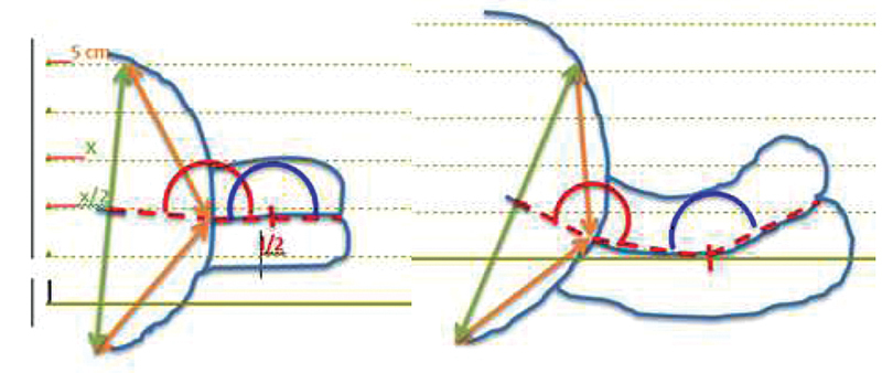 Transvaginal Sonographic Assessment Following Cervical Pessary Placement for Preterm Birth Prevention.