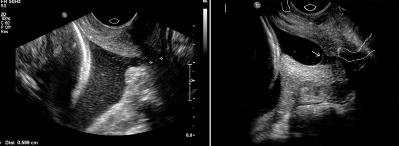 Transvaginal Sonographic Assessment Following Cervical Pessary Placement for Preterm Birth Prevention.