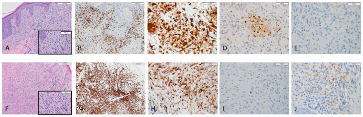Polarization of Macrophages in Granulomatous Cutaneous T Cell Lymphoma Granulomatous Mycosis Fungoides Microenvironment.