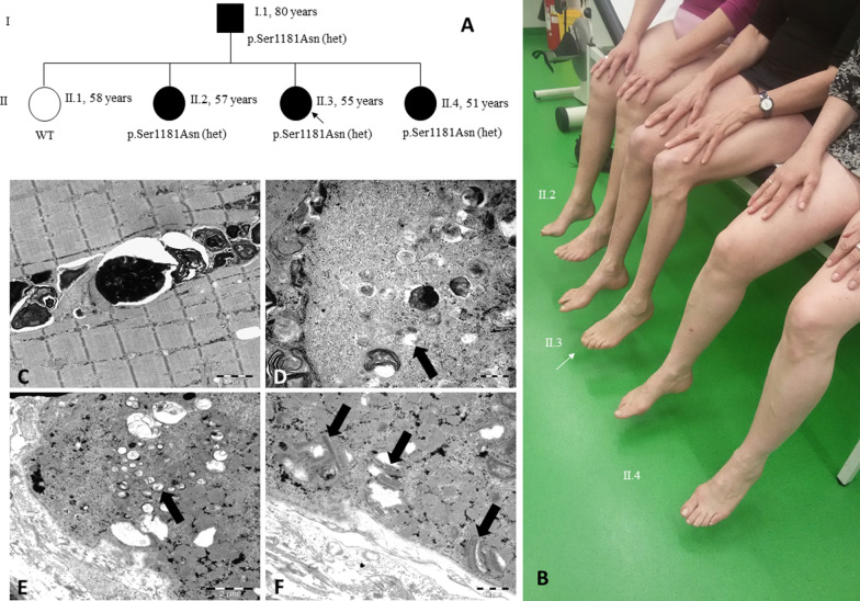 Heterozygous POLG variant Ser1181Asn co-segregating in a family with autosomal dominant axonal neuropathy, proximal muscle fatigability, ptosis, and ragged red fibers.