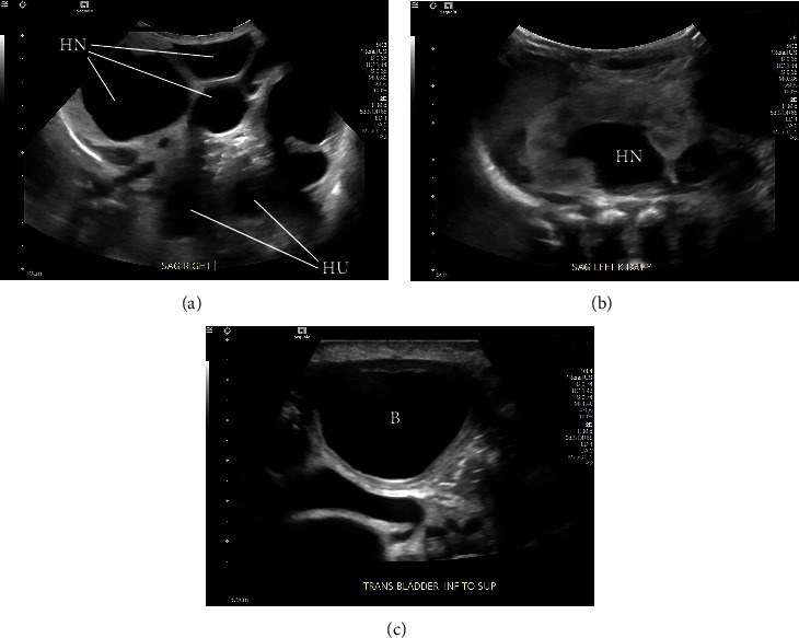 Prune Belly Syndrome Associated with Interstitial 17q12 Microdeletion.