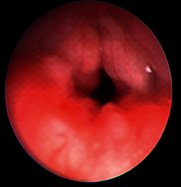 Farber Disease Mimicking Juvenile Idiopathic Arthritis: The First Reported Case in Qatar and Review of the Literature.