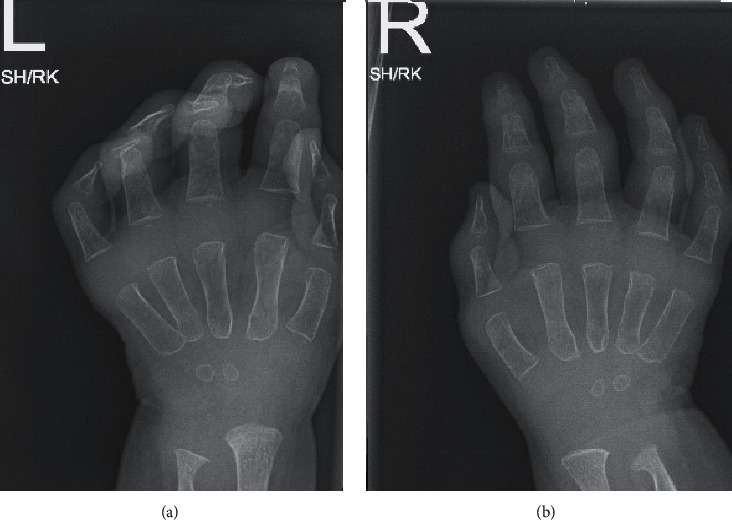 Farber Disease Mimicking Juvenile Idiopathic Arthritis: The First Reported Case in Qatar and Review of the Literature.