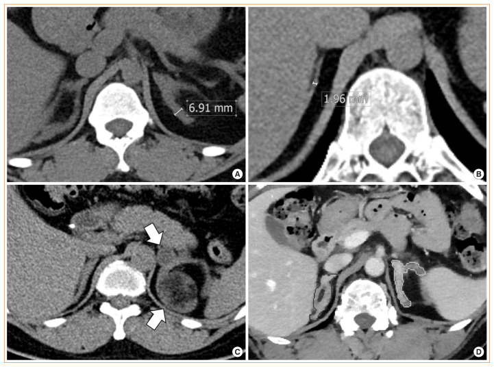 Adrenal Morphology as an Indicator of Long-Term Disease Control in Adults with Classic 21-Hydroxylase Deficiency.