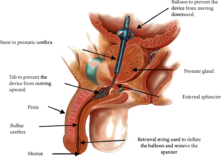 Extended Use of The Spanner® Temporary Prostatic Stent in Catheter-Dependent Men with Comorbidities.