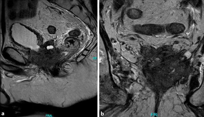 [Pelvic exenteration in patients with locally advanced, symptomatic castration-resistant prostate cancer].