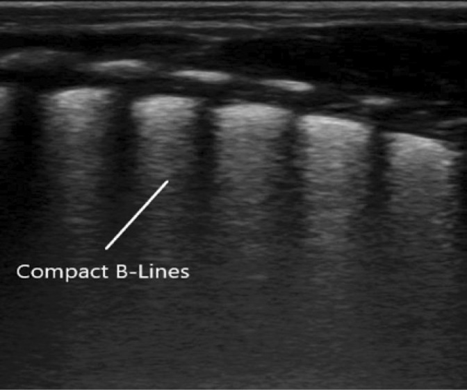 Role of lung ultrasound in diagnosing and differentiating transient tachypnea of the newborn and respiratory distress syndrome in preterm neonates.