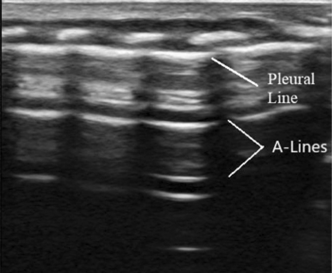 Role of lung ultrasound in diagnosing and differentiating transient tachypnea of the newborn and respiratory distress syndrome in preterm neonates.