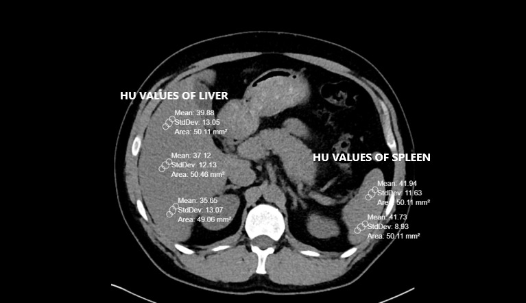 Is Fat Deposition of Renal Sinus a Concomitant Finding to Fatty Liver Disease? The First Study Regarding the Relationship Between Kidney and Liver Fat Content with Non-Contrast Computed Tomography.
