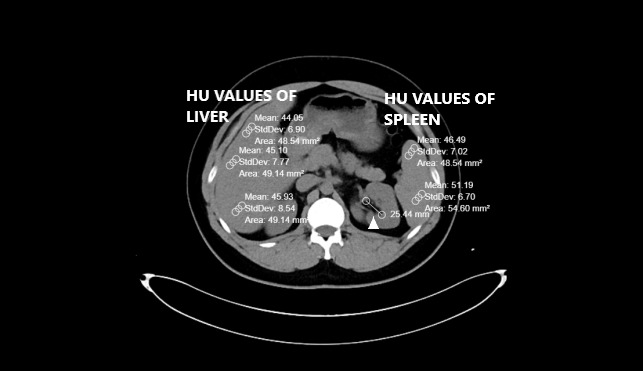 Is Fat Deposition of Renal Sinus a Concomitant Finding to Fatty Liver Disease? The First Study Regarding the Relationship Between Kidney and Liver Fat Content with Non-Contrast Computed Tomography.