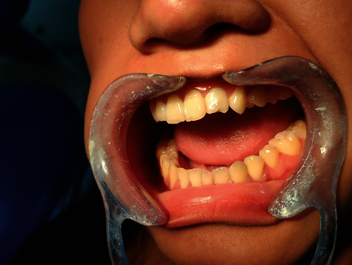 Cooccurrence of Talon's Cusp with Dens Invaginatus in the Maxillary Lateral Incisor: A Case Report with Review of Literature.