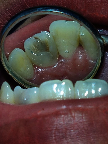 Cooccurrence of Talon's Cusp with Dens Invaginatus in the Maxillary Lateral Incisor: A Case Report with Review of Literature.