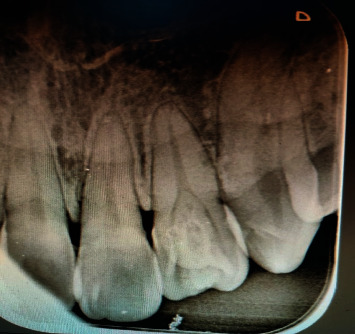 Cooccurrence of Talon's Cusp with Dens Invaginatus in the Maxillary Lateral Incisor: A Case Report with Review of Literature.
