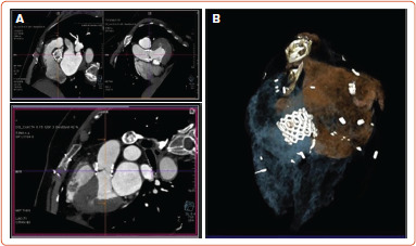 Dual Antiplatelet Regimens for Transcatheter Aortic Valve Replacement and Corresponding Cardiac CT Evaluation of the Leaflets: Single-center Experience.