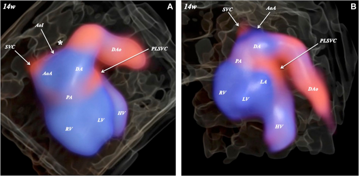 Coarctation of the aorta and persistent left superior vena cava: HDlive Flow features at 14 weeks of gestation.