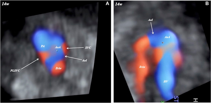 Coarctation of the aorta and persistent left superior vena cava: HDlive Flow features at 14 weeks of gestation.