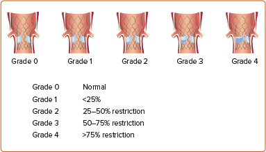 Dual Antiplatelet Regimens for Transcatheter Aortic Valve Replacement and Corresponding Cardiac CT Evaluation of the Leaflets: Single-center Experience.