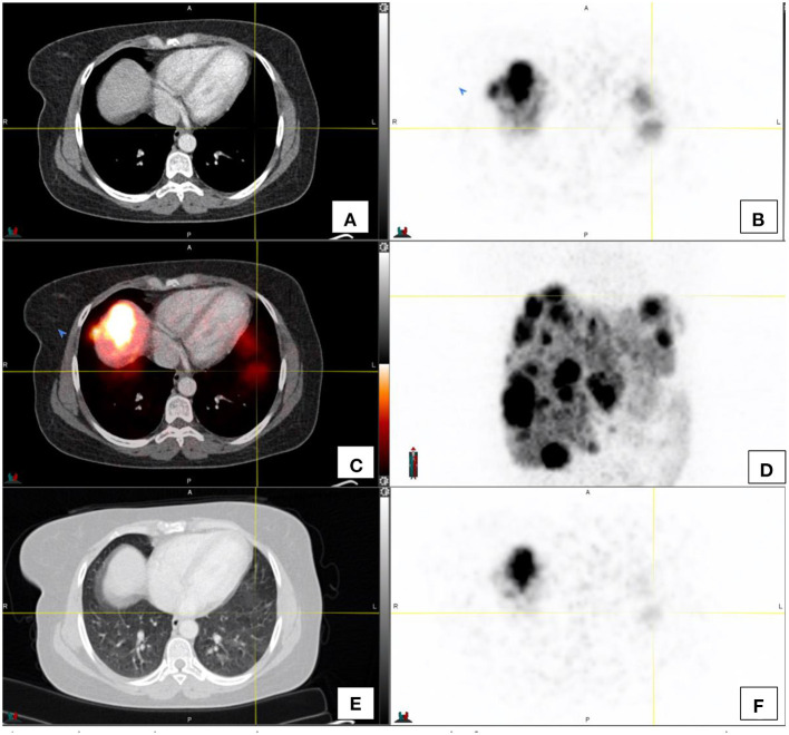 Normal Variants, Pitfalls and Artifacts in Ga-68 DOTATATE PET/CT Imaging.