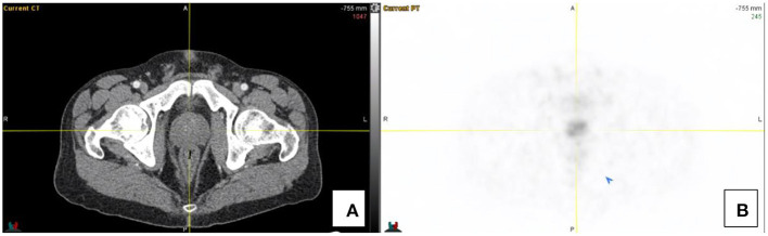 Normal Variants, Pitfalls and Artifacts in Ga-68 DOTATATE PET/CT Imaging.