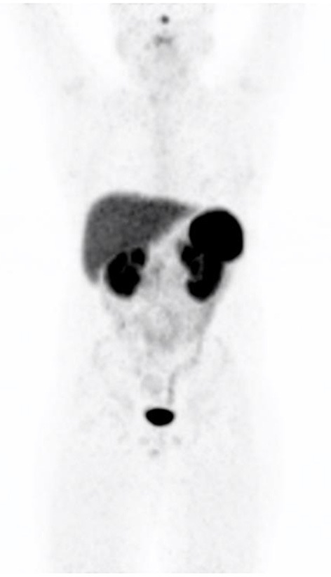 Normal Variants, Pitfalls and Artifacts in Ga-68 DOTATATE PET/CT Imaging.