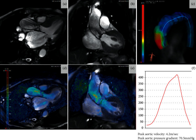 Valvular Cardiomyopathy: The Value of Cardiovascular Magnetic Resonance Imaging.