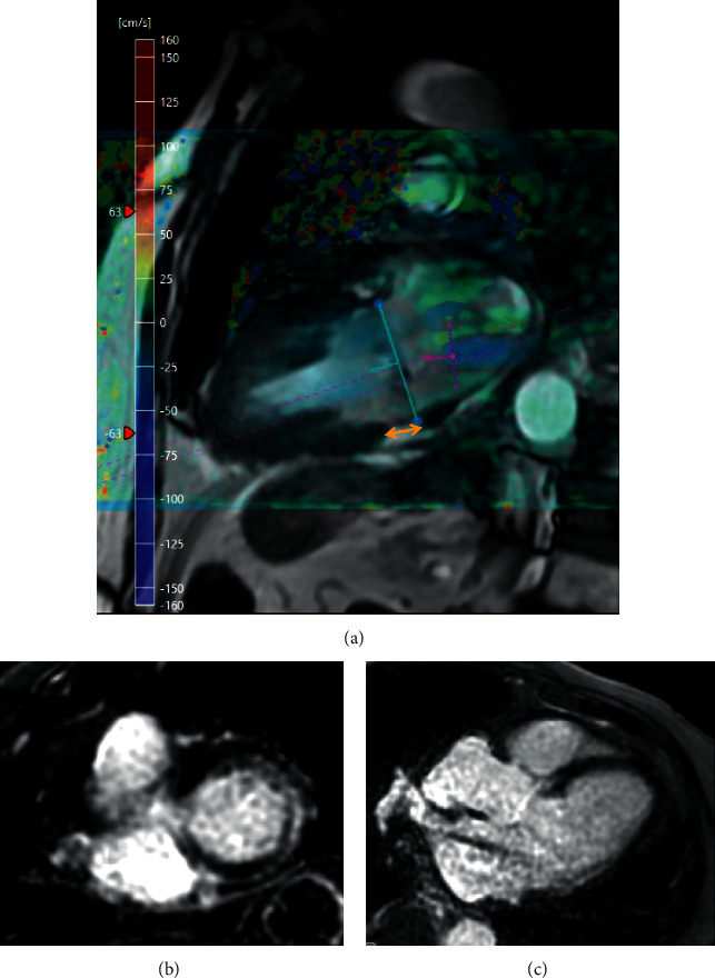 Valvular Cardiomyopathy: The Value of Cardiovascular Magnetic Resonance Imaging.