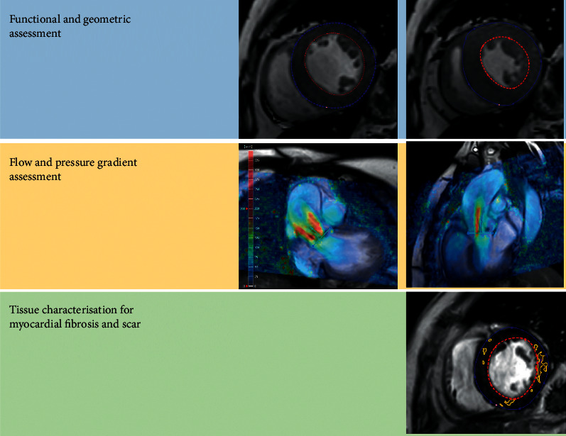 Valvular Cardiomyopathy: The Value of Cardiovascular Magnetic Resonance Imaging.