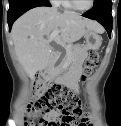 Migration of bird feather into bile duct mimicking bile duct stone recurrence: First-ever case report