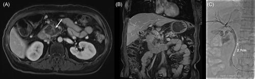 Acute cholangitis due to food reflux after self-expanding metal stent implantation without duodenal obstruction: A case report